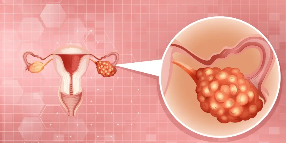 Ovarian cancer awareness for women